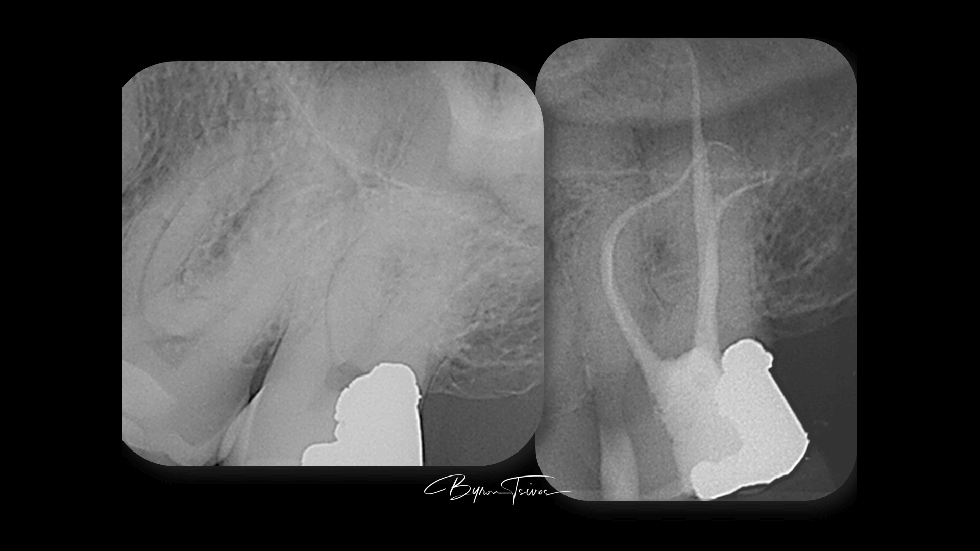 Complex Anatomy - Case 20